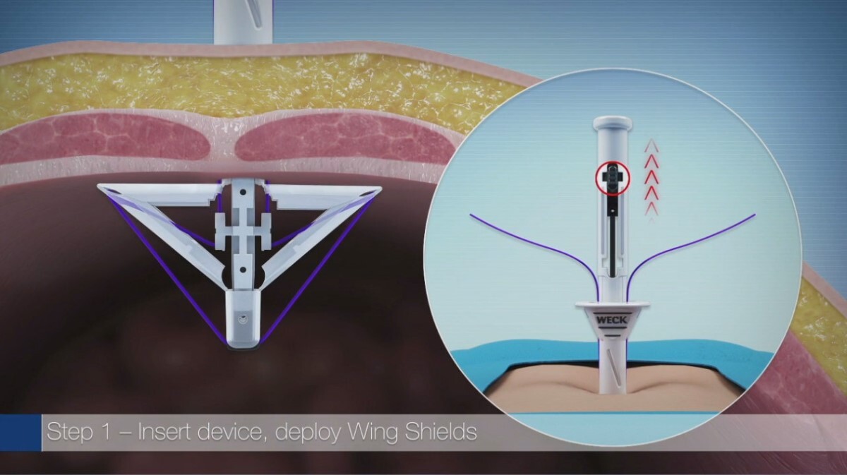 Weck® EFx Shield® Fascial Closure System | Weck® EFx Shield® Fascial ...