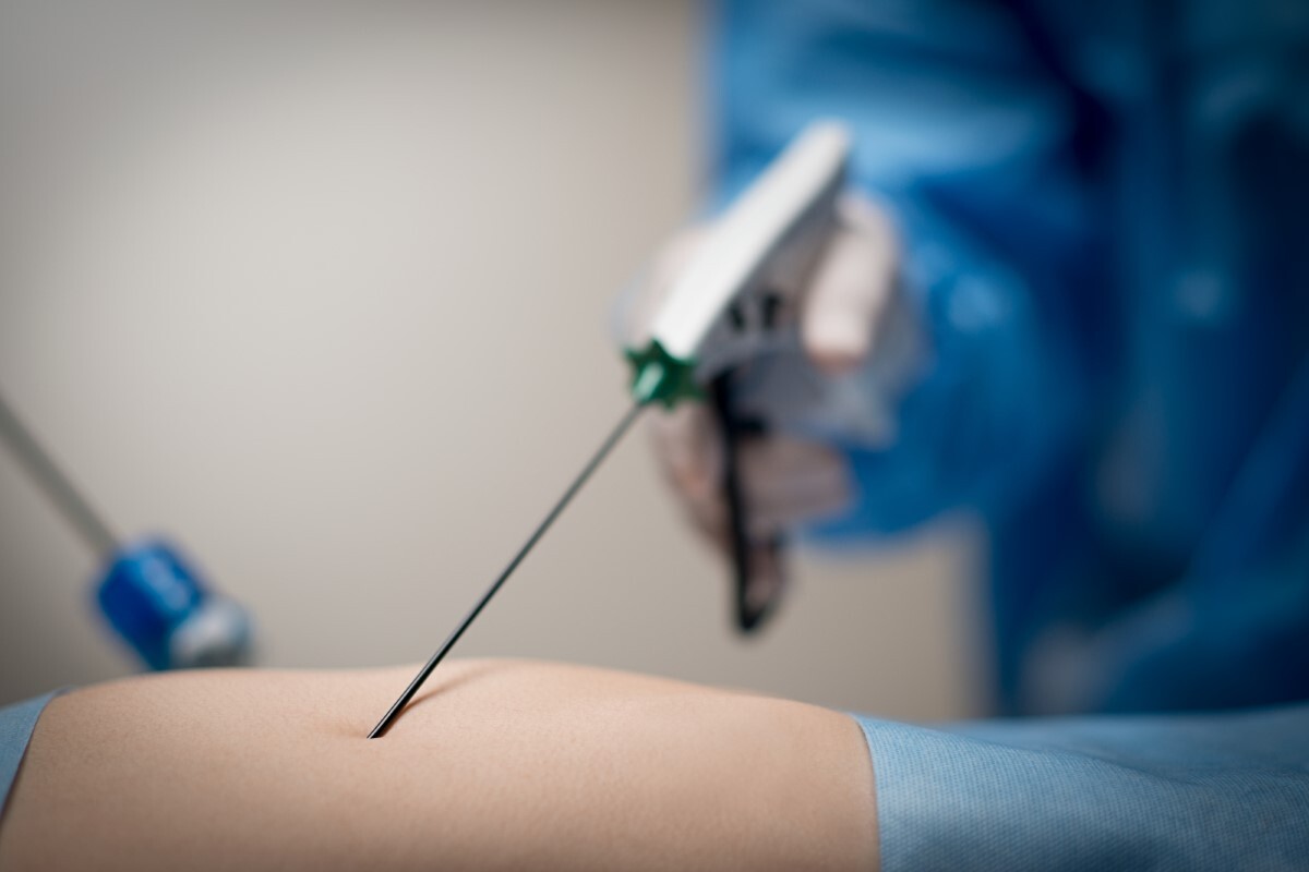 Minlap MiniLap® Graspers | MiniLap® Grasper System | Percutaneous Access ...