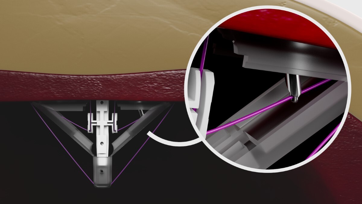 Weck® EFx Shield® Fascial Closure System | Weck® EFx Shield® Fascial ...